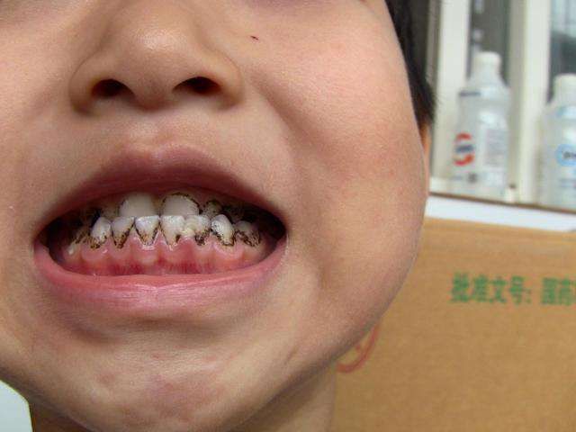 为什么我的孩子黄牙蛀牙,有什么好的办法吗?