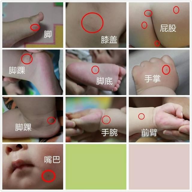 手足口疫苗要不要打?我家孩子打针产生的反应，都是医生没说过的!