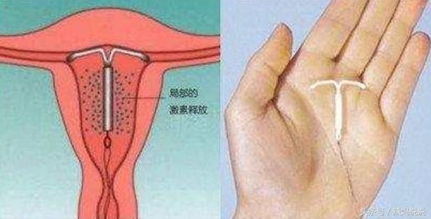 女性生下孩子没多久就选择上环的,你们知道会遇到什么问题吗