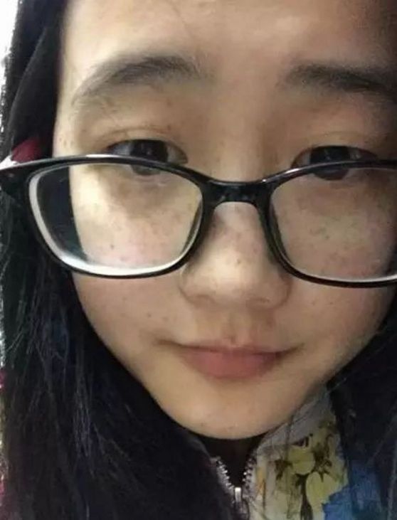 24岁女大学生因为脸上祛斑太多被多家学校拒
