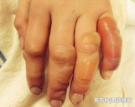 俄罗斯美女聚会后醉倒,在街上冻了一晚,醒后发现手指“变异”了