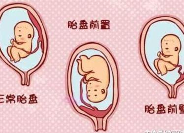 孕期, 胎盘前壁生男孩? 胎盘低置易流产? 关于