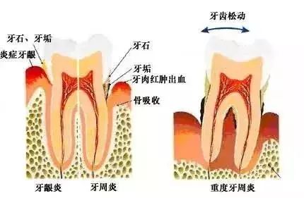 牙齿矫正会导致牙齿松动? 其实是你牙龈萎缩了