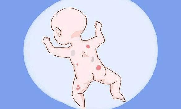 请注意!你家宝宝胎记的位置很重要,长在这个地