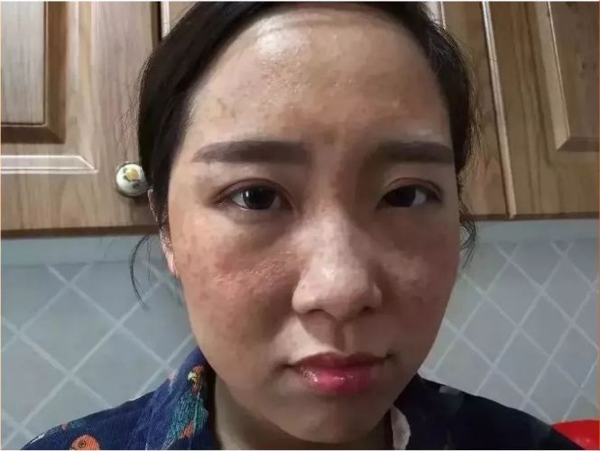 背后有黑色斑是病吗 t01cd37186f560bcf7e.jpg