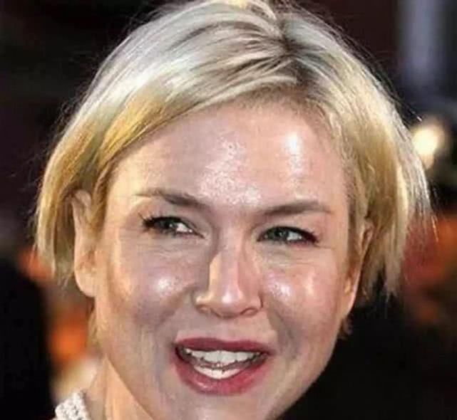 脸绷是激素脸吗