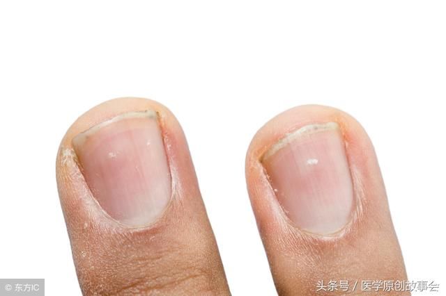 指甲出现五种改变提示该体检了,拖久了会变成这五种病