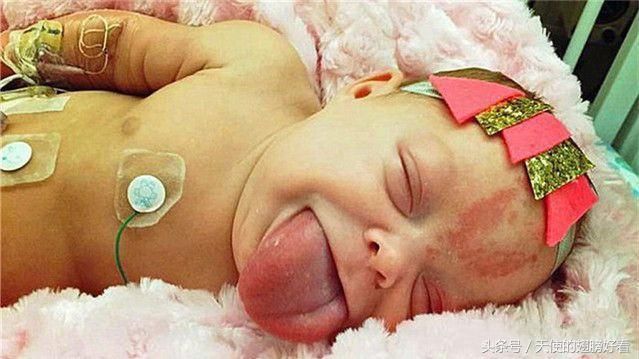 刚出生女婴患罕见怪病,人未长大器官就疯长,但
