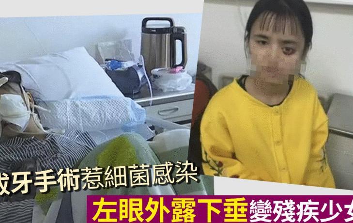 4岁拔牙受肌肉坏死,贵州女孩女生动漫感染左在面部海里的细菌图片