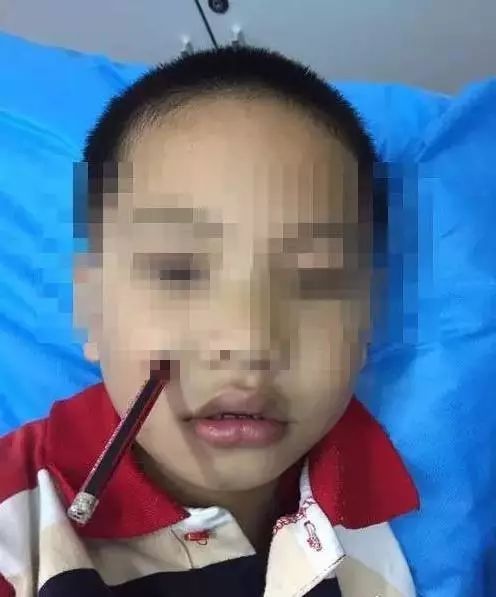 赣州6岁男童不慎跌倒,铅笔从左脸插进眼睛