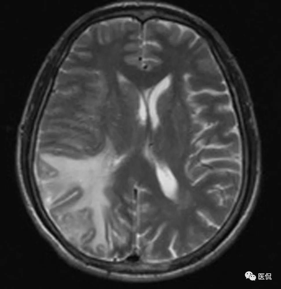 头痛头晕,MRI特点为右侧顶颞枕部脑膜强化、以