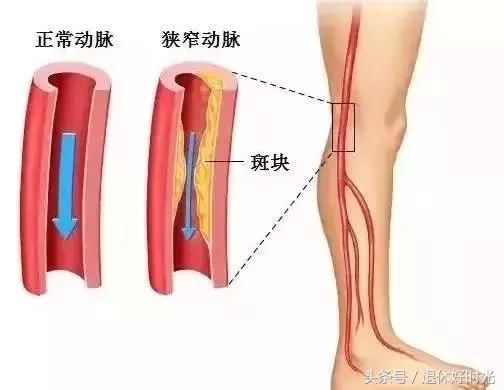 中老人年人腿抽筋，别盲目补钙！这些才是真正原因……