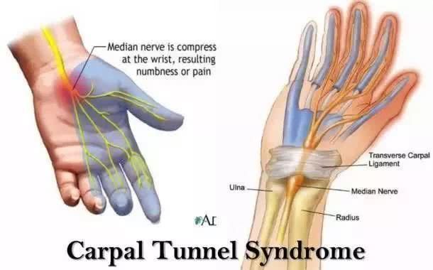 【北京美勤健身学院教育科普】腕管综合征的纠
