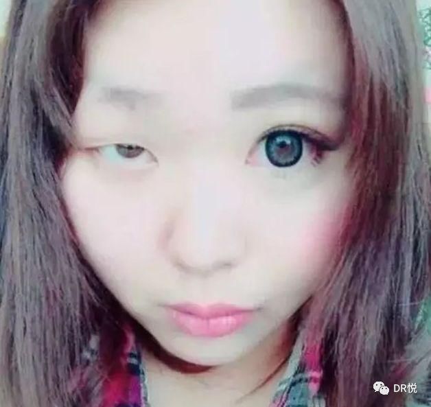 怎样选择适合自己的双眼皮贴 t01e0d592c023cfba7b.jpg
