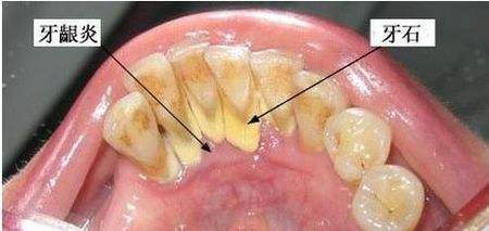 科普--口腔的恶魔牙结石形成的条件?_【快资讯
