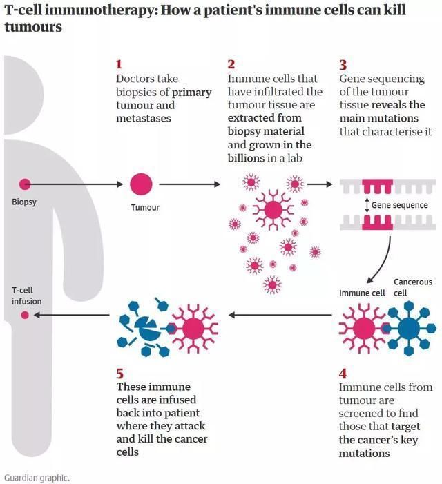 全球首次免疫疗法治愈乳腺癌末期!扩散全身的癌细胞完全消除