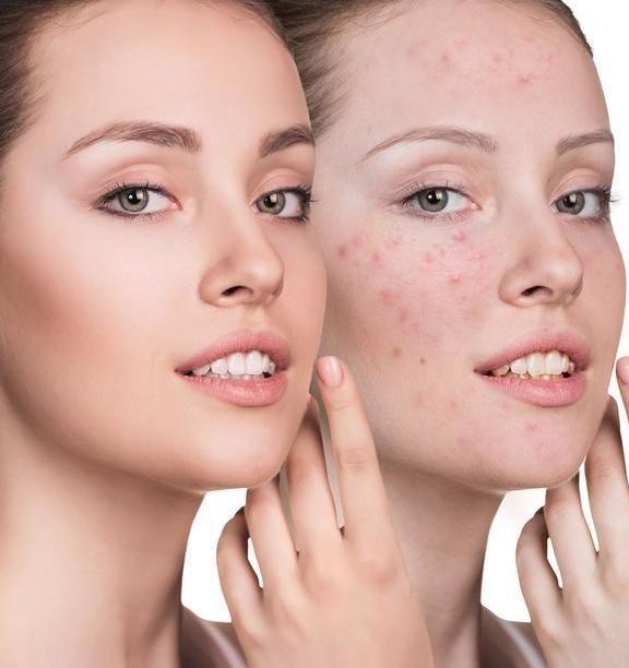 脸上坑坑洼洼好像月球表面?这其实是螨虫作怪