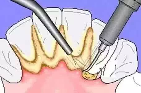 口腔的恶魔牙结石形成的条件是什么?