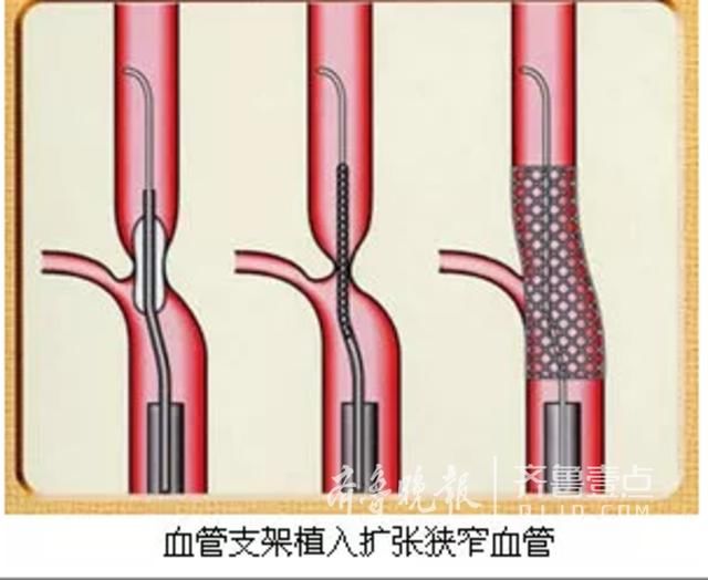 牛!济阳县医院完成一例重度复杂冠状动脉支架