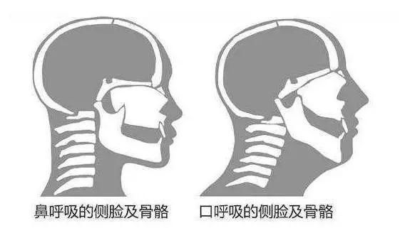 打呼噜会让你“变丑”！1分钟自查打鼾的你是否该就医