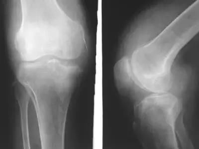 日行3万步走断大腿骨，每天走多少步才健康？