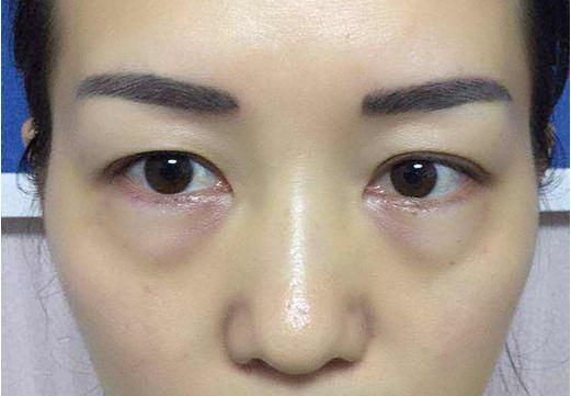 没想到火龙果皮居然是眼袋的克星,只用了2次就