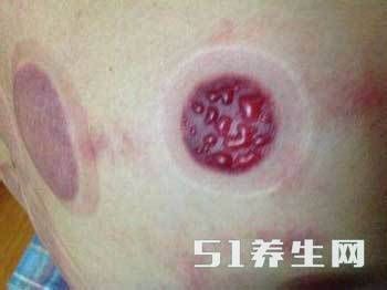 你还在吃薏米排湿气吗?难怪没效果,老中医说吃这个,湿气一扫而