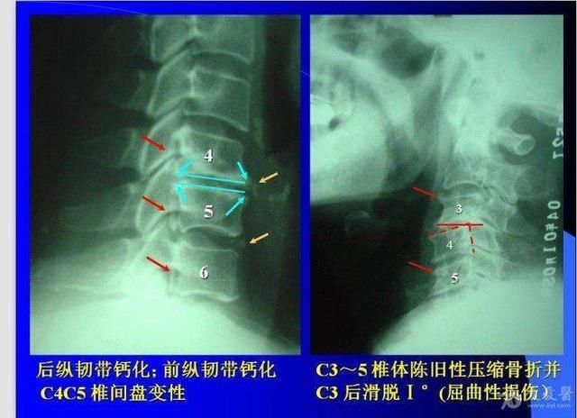 睡觉时不枕枕头能治颈椎病吗?