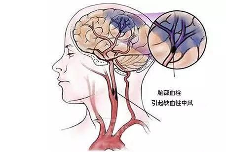 有没有脑梗，画个圈就知道！一味药治脑梗，护心脑血管，非常了得