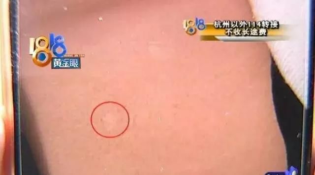 两个白点,“丽都”没确诊,花了近六千!又去三甲医院,只花两百