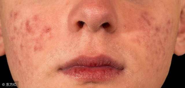 初期痤疮的症状有哪些?最为主要的几大针对于