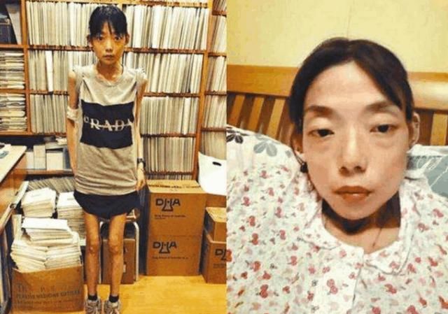 22岁嫁入豪门,在病重时被丈夫抛弃,离婚后瘫痪骨瘦如柴不成人形