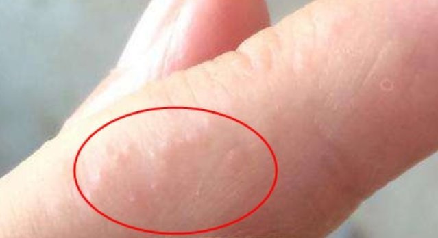 手上长出“小水泡”,原来是它在作怪,该怎么办呢? 10BET娱乐网