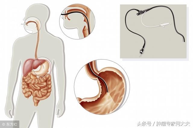 微信群里，同学老婆死了，39岁，胃癌，胃癌怎么得的?如何筛查？