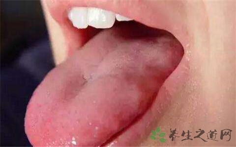 创伤性口腔溃疡吃什么药