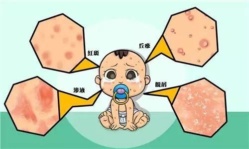 “婴幼儿湿疹”的那些流言，你了解吗?