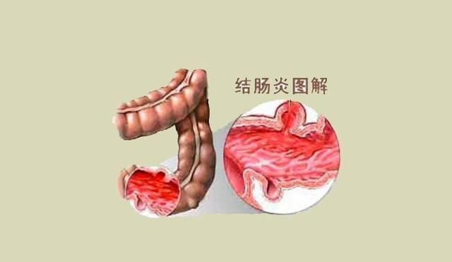 大便带血？由便血看出来的健康问题，这些信号你该注意了