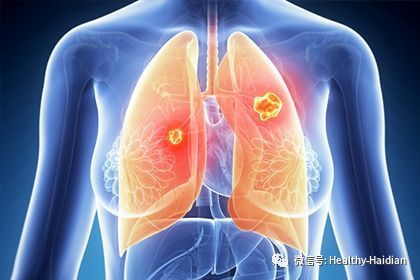 低剂量螺旋CT的射线伤害到底有多大?