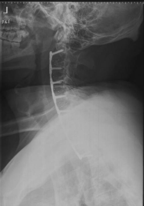 院在国际上首次采用颈前路椎体前移术,一次性