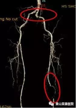 黄山首康医院普外科完成黄山市第一例双下肢动