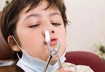 孩子患了过敏性鼻炎怎么办?自我疗法三部曲
