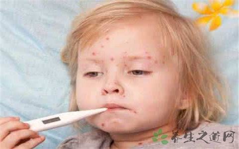 慢性荨麻疹会传染吗