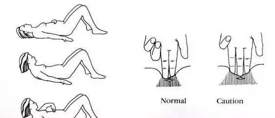 腹直肌分离的常见误区，与4步完整处理方案！