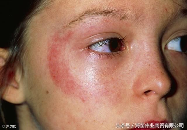 海英:皮肤经常过敏的原因和应对方法