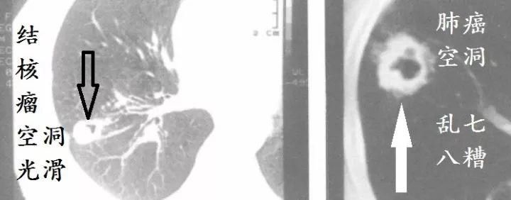 肺CT也会装酷:如何从CT上看出肺癌的病理类型?